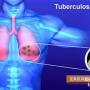 РЗИ продължава кампанията против туберкулоза